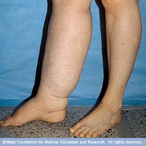 lymphedema in the right leg